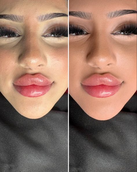 Lip Filler Swelling, Russian Lips, Lip Flip, Big Lips Natural, Lip Blushing, Heart Shaped Lips, Bollywood Makeup, Lips Inspiration, Face Fillers