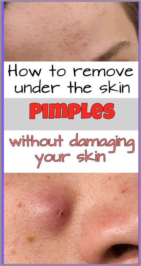 How to Remove Under the Skin Pimples Without Damaging Your Skin Under The Skin Pimples, Pimples Under The Skin, Health Signs, Under The Skin, Acne Cream, Health Facts, Homecoming Makeup, The Skin, Healthy Tips