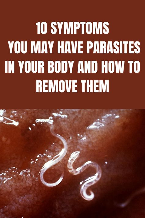 10 Symptoms You May Have Parasites in your Body (and how to remove them) Parasites Symptoms, Yoga Information, Natural Remedies For Migraines, Parasite Cleanse, Dry Skin Remedies, Home Remedies For Hair, Cold Home Remedies, Natural Health Tips, Health And Beauty Tips