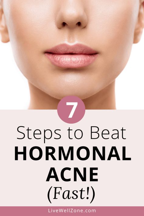 Healthy Skin Care Acne, Get Rid Of Hormonal Acne, Hormonal Acne Diet, Acne Supplements, Hormonal Acne Remedies, Face Mapping Acne, Acne Diet, Acne Skincare Routine, Natural Acne Remedies