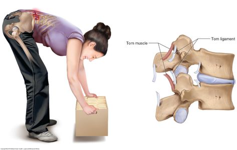 The two most common causes for a low back sprain / strain are macrotrauma and repetitive microtraumas, often involving bending and lifting… Bad Sleeping Habits, Causes Of Back Pain, Back Strain, Spinal Injury, Muscle Strain, Medical Anatomy, What To Use, Medical News, Poor Posture