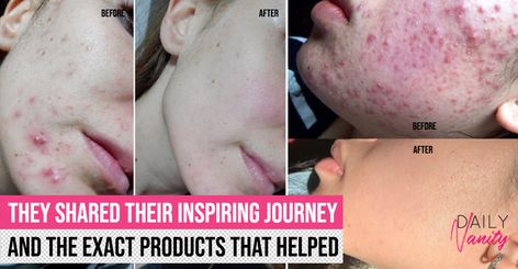 20 most incredible before-and-after photos of Redditors and the routines that transformed their skin - Daily Vanity Differin Gel Before And After, Niacinamide Before And After, Differin Gel, Healing Ointment, Benzoyl Peroxide, Alcohol Free Toner, Cystic Acne, Broad Spectrum Sunscreen, First Aid Beauty