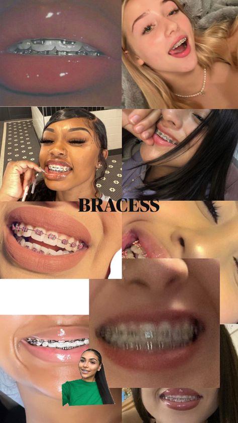 Braces Tips, Cute Braces, Matching Halloween Costumes, Braces Colors, Dental Braces, Perfect Teeth, Matching Halloween, Short Acrylic Nails Designs, Short Acrylic Nails