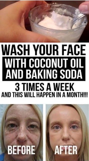 Coconut Oil Face Wash, Baking Soda Face Scrub, Coconut Oil And Baking Soda, Oil Face Wash, Baking Soda Coconut Oil, Obličejové Masky, Baking Soda Face, Coconut Oil For Face, Skin Care Wrinkles