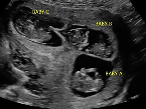 An early first trimester ultrasound with triplets. 10 Week Ultrasound, Pregnant With Triplets, Baby Ultrasound Pictures, Triplets Pregnancy, Pregnancy Ultrasound, Bump Pictures, Baby Ultrasound, Triplet Babies, Twin Baby Girls