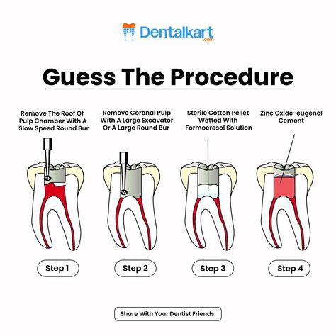 🦷 Guess the Procedure! 🦷

Can you identify the dental procedure shown in these 4 steps?

1️⃣ Remove the roof of the pulp chamber with a round bur
2️⃣ Remove coronal pulp with a large excavator
3️⃣ Apply a cotton pellet with Formocresol Solution
4️⃣ Seal with Zinc Oxide-eugenol cement

Comment your answer below! 🧐👇
Share with your dentist friends and see who gets it right!
#Dentalkart #Endodontics #PulpChamber #CoronalPulp #DentalKnowledge #PulpTherapy #InteractiveSession #DentalEducation Dental Procedures, Zinc Oxide, Dental Clinic, The Roof, Cement, Roof, How To Apply