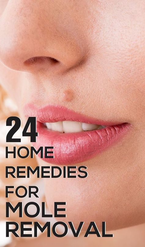 Is your beauty being destroyed because of moles? Mole removal may be quite painful,follow these effective home remedies for mole removal which are safe & easy. What Causes Warts, Cancerous Moles, Warts On Hands, Warts On Face, Skin Moles, Skin Growths, Mole Removal, Get Rid Of Warts, Positive Habits