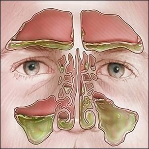 Nasal mucus color: What does it mean? Color Of Mucus Meaning, Yellow Mucus From Nose, Mucus Color, Yellow Mucus, Q And A, Health Questions, Sinus Infection, Bacterial Infection, Natural Therapy