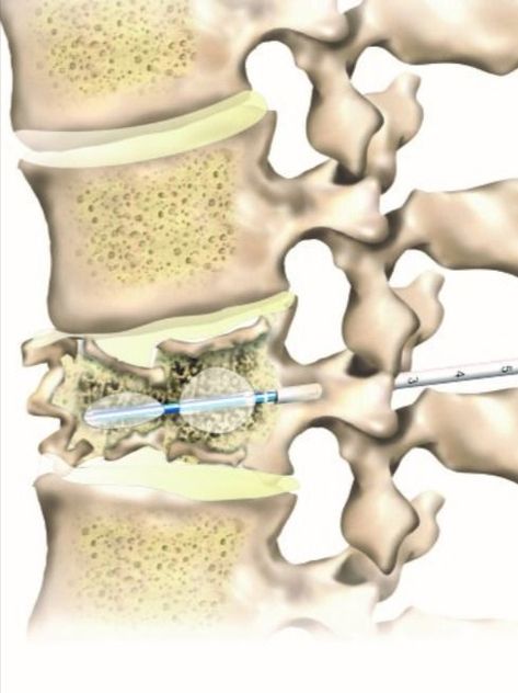 Kyphoplasty is a minimally invasive surgical procedure commonly used for spinal compression fractures as it stabilizes the fracture. If you are experiencing a back fracture, call our specialists at 888-409-8006. #spinedoctor #backpain Lumbar Pain, Bone Fracture, Pinched Nerve, Spine Surgery, Sciatic Nerve Pain, Sciatic Nerve, Bone Density, Market Analysis, Body Pain