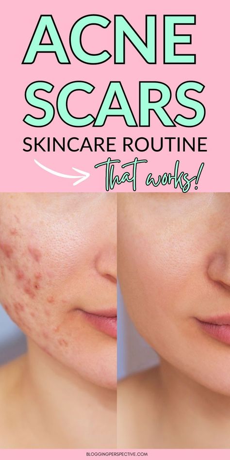 Struggle with acne scars? Discover proven methods and acne scar remedies that work wonders. Our detailed guide dives into effective acne scar treatments and the best acne scar products on the market. Learn about targeted acne scar skin care routines that help heal and restore your skin. For all the must-know details, check out these ideas on the blog today! Acne Scarring Remedies, Acne Skin Care Routine Products, Healing Acne Scarring, Acne Scar Skin Care Routine, Acne Scar Products, Acne Scar Skin Care, Best Makeup For Acne, Acne Scar Remedies, Scar Remedies