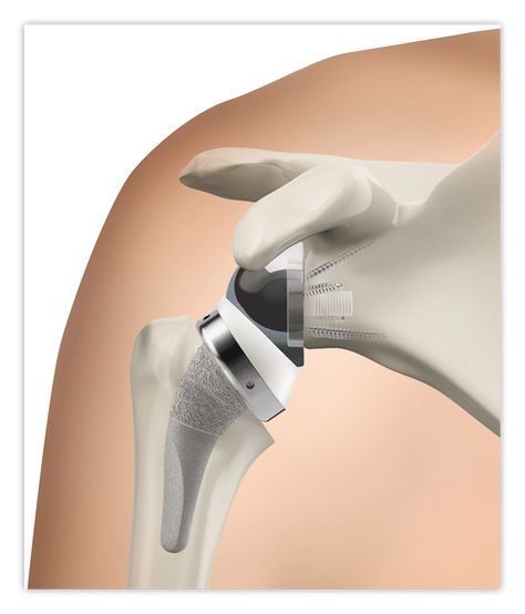 Reverse Shoulder Arthroplasty Stryker Medical, Reverse Shoulder Replacement, Hip Implants, Ankle Pain, Shoulder Injuries, Rotator Cuff, Knee Replacement, Nerve Damage, Hip Pain