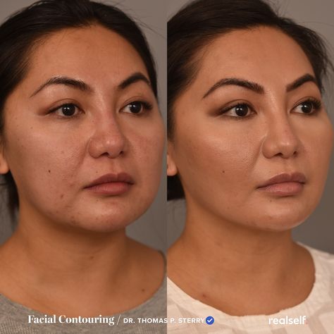 It typically takes a week of recovery time for the cheek tissue to heal after buccal fat removal surgery. Buckle Fat Removal, Buccal Fat Removal, Cheek Fat, Face Fat, Plastic Surgery Procedures, Slimmer Face, Women Health Care, Chubby Cheeks, Beauty Tips For Skin