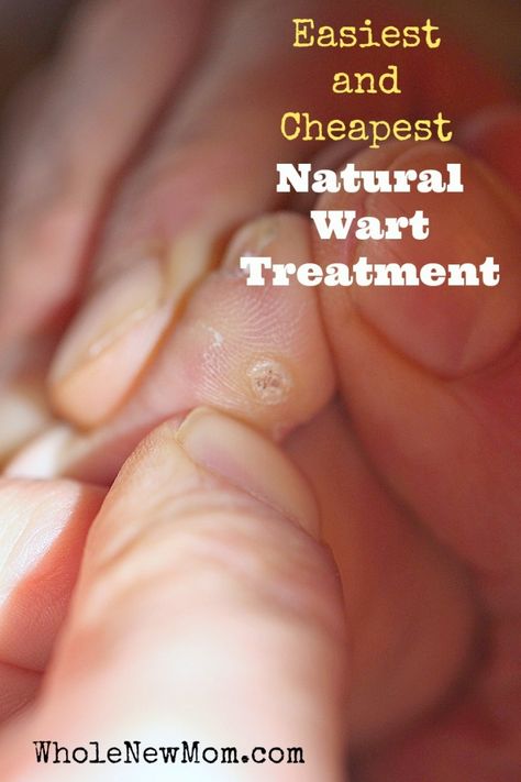 Natural Plantars Wart Remedy. You won't believe this!#health #wellness #warts #natural #remedies #diy Planters Wart, Natural Wart Remedies, Warts On Face, Home Remedies For Warts, Warts Remedy, Cold Sores Remedies, Natural Sleep Remedies, Natural Cold Remedies, Natural Cough Remedies