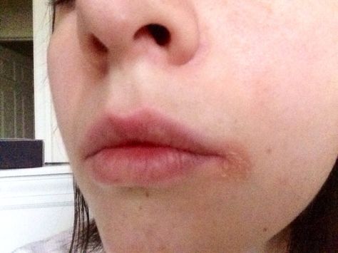 Angular Cheilitis, Diy Herbal Remedies, Cracked Lips, Herbal Remedies, Home Remedies, Wordpress, Lips, Healing, Skin