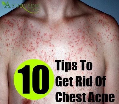 10 Tips To Treat Chest Acne Get Rid Of Chest Acne, Treating Cystic Acne, Hormonal Acne Remedies, Overnight Acne Remedies, Chest Acne, Baby Acne, Forehead Acne, Natural Acne Remedies, Dry Skin Patches