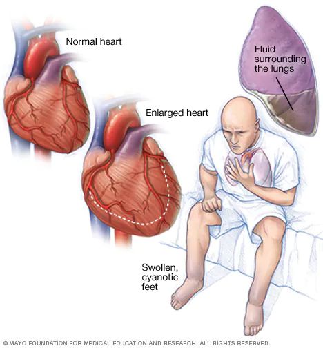 Heart failure - Symptoms and causes - Mayo Clinic Heart Symptoms, Enlarged Heart, Heart Valves, Normal Heart, Heart Defect, Congenital Heart, Heart Care, Heart Muscle, Cardiovascular System