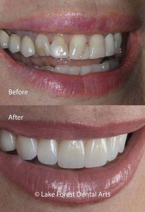 Zirconia crowns before and after Cosmetic Dentistry Before And After, Dental Veneers Before And After, Teeth Veneers Before And After, Veneers Before And After, Teeth Makeover, Cosmetic Dentistry Veneers, Veneers Teeth, Aesthetic Dentistry, Beautiful Teeth