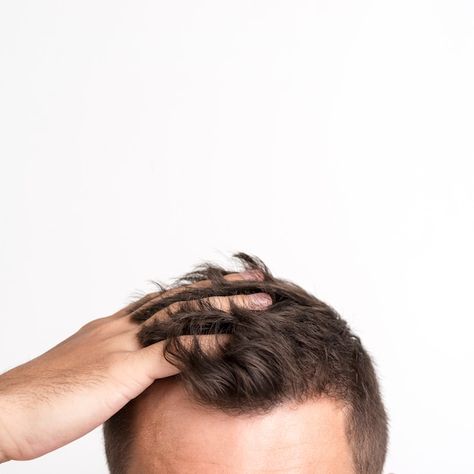 Hair Fall Problem, Hair Implants, Dunner Wordend Haar, Beauty Procedures, Best Hair Transplant, Hair Control, Lost Hair, Hair Problems, Hair Fall