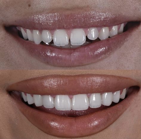 Teeth Correction, Perfect Skin Routine, Fix Teeth, Teeth Aesthetic, Cosmetic Dentistry Procedures, Veneers Teeth, Aesthetic Dentistry, Beautiful Teeth, Porcelain Veneers