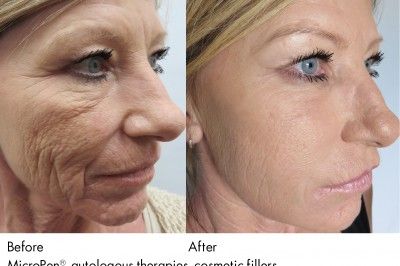 Microneedling with PRP (Vampire Facial) Before-After Pola Bear, Facial Before And After, Facial Procedure, Derma Rolling, Face Surgery, Vampire Facial, Plasma Pen, Skin Needling, Micro Needling