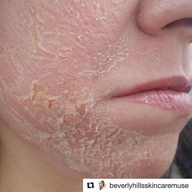 Such a good result by @beverlyhillsskincaremuse using the CosMedix Deep Sea Peel. While not everyone needs this level of peeling, for… Clinic Poster, Peeling Skin, Skin Diseases, Chemical Peel, New Skin, Skin Texture, Dermatology, Dull Skin, Face Skin