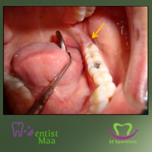 The wisdom teeth are the third molars, that are the last teeth to erupt in your mouth. The age of eruption of wisdom teeth, is approximately 17 years to 21 years. Any wisdom tooth that do not erupt at their proper position but are present in the jaw are called Impacted teeth. Most of the […] Impacted Wisdom Teeth, Loose Teeth, Impacted Tooth, Wisdom Tooth Extraction, Wisdom Tooth, Molar Tooth, Loose Tooth, Holistic Health Remedies, Tooth Extraction