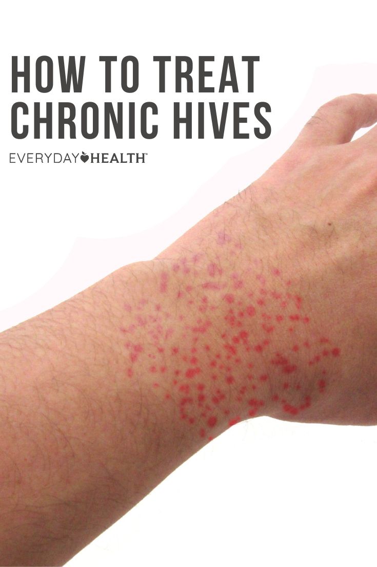 When it comes to treating hives, there are many home remedies that can help. Doctors say DO moisturize your skin, but skip the over-the-counter anti-itch creams (which can actually make the hives worse). Get Rid Of Hives Fast, How To Treat Hives, Remedies For Hives, Allergy Hives, Home Remedies For Hives, Itching Remedies, Hives Remedies, Chronic Hives, The Hives