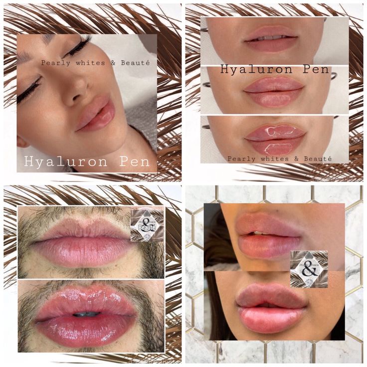 Pouty Lips Injections, Hyaluron Pen Lip Filler, Lip Filler Injection, Cosmetic Lip Tattoo, Filler Injection, Hyaluronic Acid Lips, Esthetician School, Hyaluronic Acid Fillers, Lip Blush