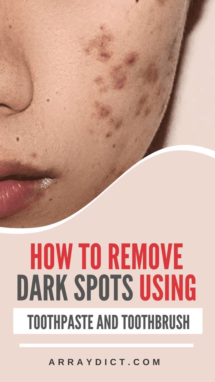 Brown Spots On Hands, Dark Spots Remedies, Brown Age Spots, Brown Spots On Skin, Dark Spots On Face, Diy Anti Aging, Brown Spots Removal, Brown Spots On Face, Dark Spots On Skin