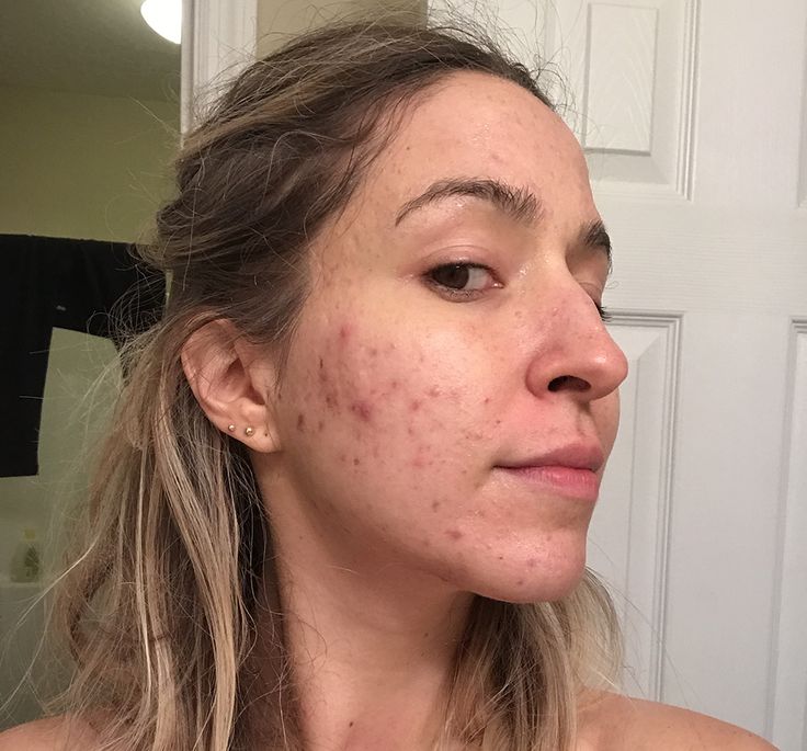 The Secret that Cleared My Severe, Hormonal, Cystic, Itchy, Adult Acne after 17 Years – Part 2 – Brooke's Beauty Bazaar Hormonal Acne Recipes, Cystic Hormonal Acne, Hormonal Acne Routine, Cystic Acne Routine, Acne Diet Plan Hormonal, Hormonal Acne Tips, Clear Hormonal Acne, Hormonal Acne Skincare Routine, Acne On Cheeks