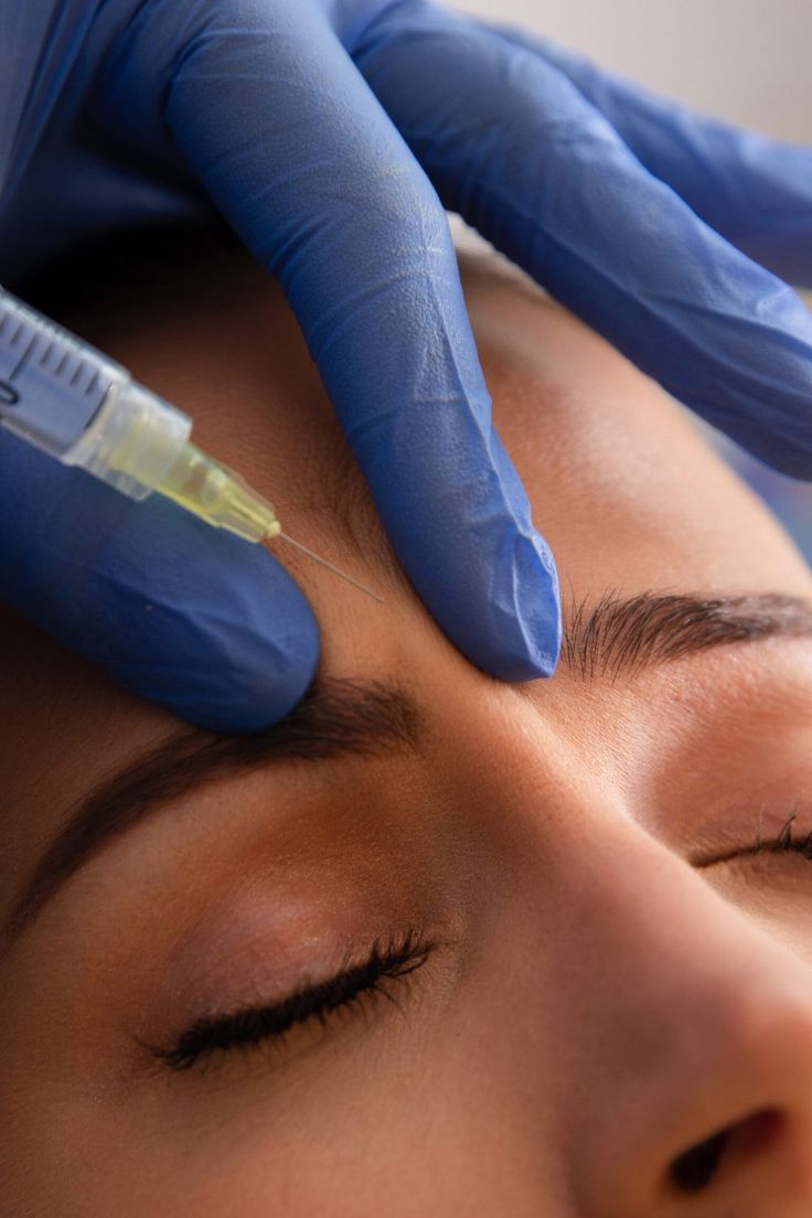 Trusted by countless expert injectors, Botox Cosmetic isn’t just a wrinkle relaxer; it’s a testament to precision and quality. Crafted in a state-of-the-art facility under stringent safety measures, each of […] Botox Nurse, Botox Aesthetic, Botox Results, Allergan Botox, Botox Cosmetic, Cosmetic Injectables, Post Insta, Aesthetic Medicine, Botox Injections