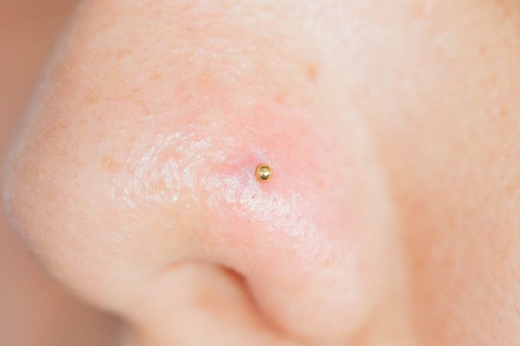 a close up of a person's nose with small bumps on it