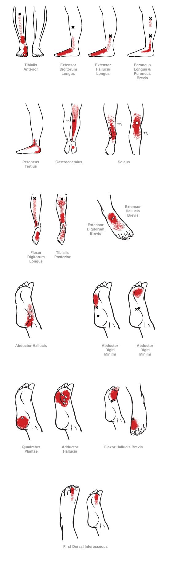 trigger point referral pain patterns for the ankle & foot Punkty Spustowe, Myofascial Pain Syndrome, Trigger Point Therapy, Trigger Point, Homemade Seasonings, Trigger Points, Massage Techniques, Reflexology, Muscle Pain