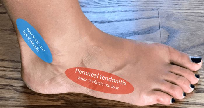 What is that pain on the outside of my foot? - Almawi Limited The Holistic Clinic Foot Pain Chart, Holistic Clinic, Podiatry Clinic, Foot Exercises, Foot Pain Relief, Ankle Pain, Sprained Ankle, Hip Pain, Heel Pain