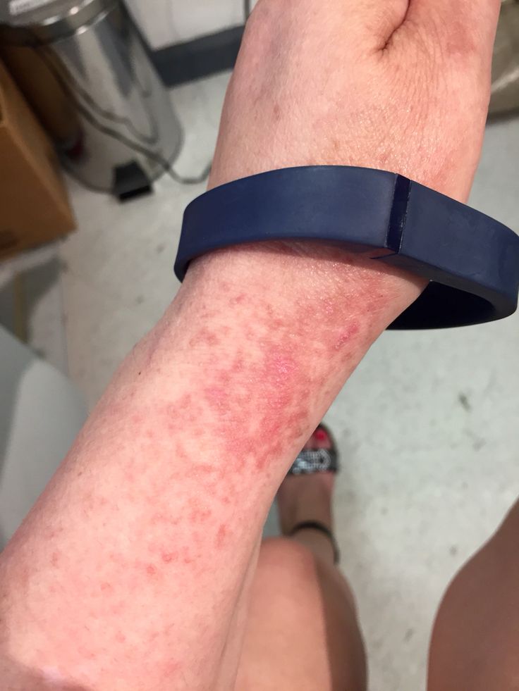 Fitbit Rash!!! Fit Bit, Health Video, As It Was, Fitbit Flex, Fitbit, Leather Bracelet, Give It To Me, Health, Leather