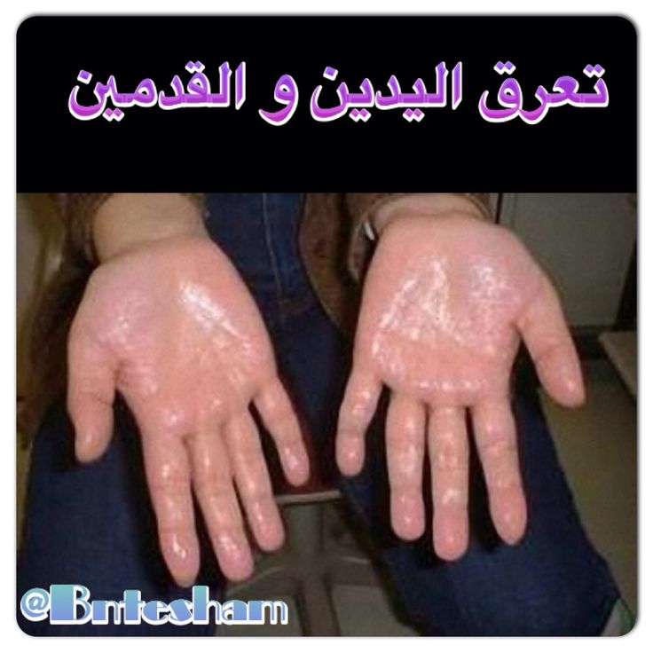 http://instagram.com/p/fTkZP8C4Nd/ Sweating Remedies, Hand Sweating, Sweaty Palms, Stop Sweating, Sweaty Hands, Excessive Sweating, Natural Home Remedies, Natural Treatments, Home Health