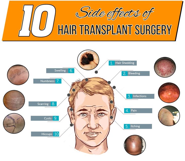 10 Side effects of Hair Transplant Surgery #hairtransplantsideeffects #hairloss #hairlosstreatment #hairtransplant #baldness Hair Transplant Women, Dramatic Hair, Hair Transplant Surgery, Hair Shedding, Hair Starting, Hair Transplant, Acne Skin, Doctor Strange, About Hair