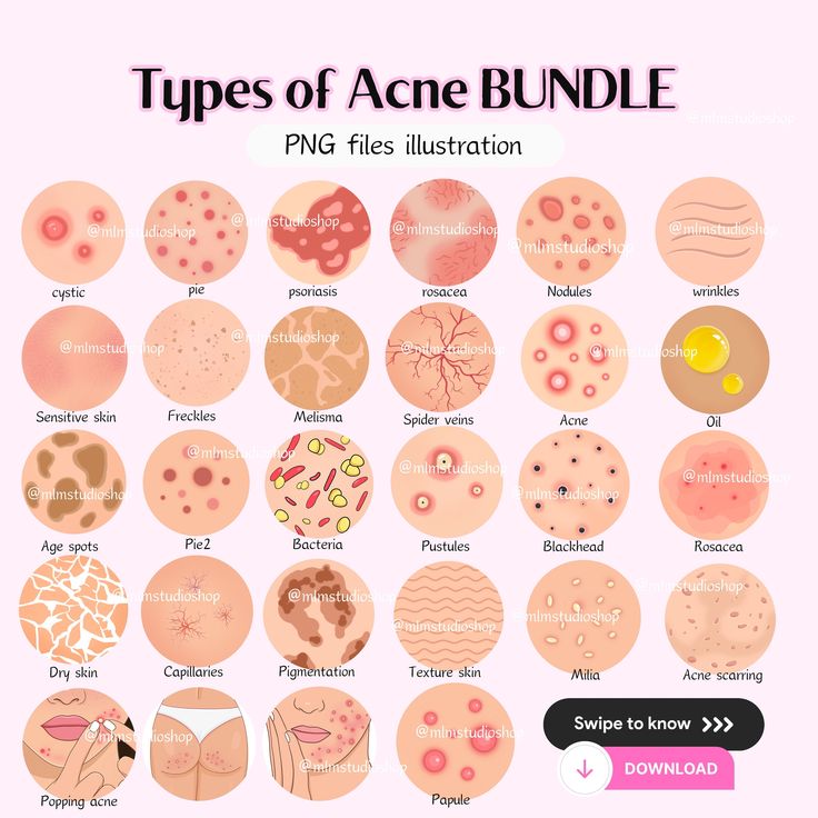 Acne Illustration, Skincare Icon, Skincare Illustration, Facial Esthetics, Different Types Of Acne, Skin Facts, Skin Care Business, Skin Advice, Skin Aesthetics