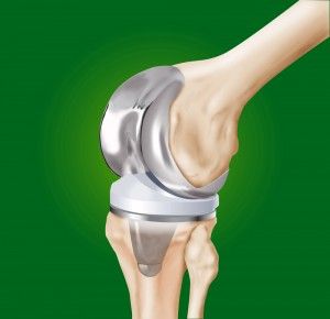 knee replacement Knee Replacement Exercises, Knee Replacement Recovery, Partial Knee Replacement, Knee Operation, Knee Health, Pain Management Techniques, Hip Fracture, Knee Replacement Surgery, Orthopedic Surgery