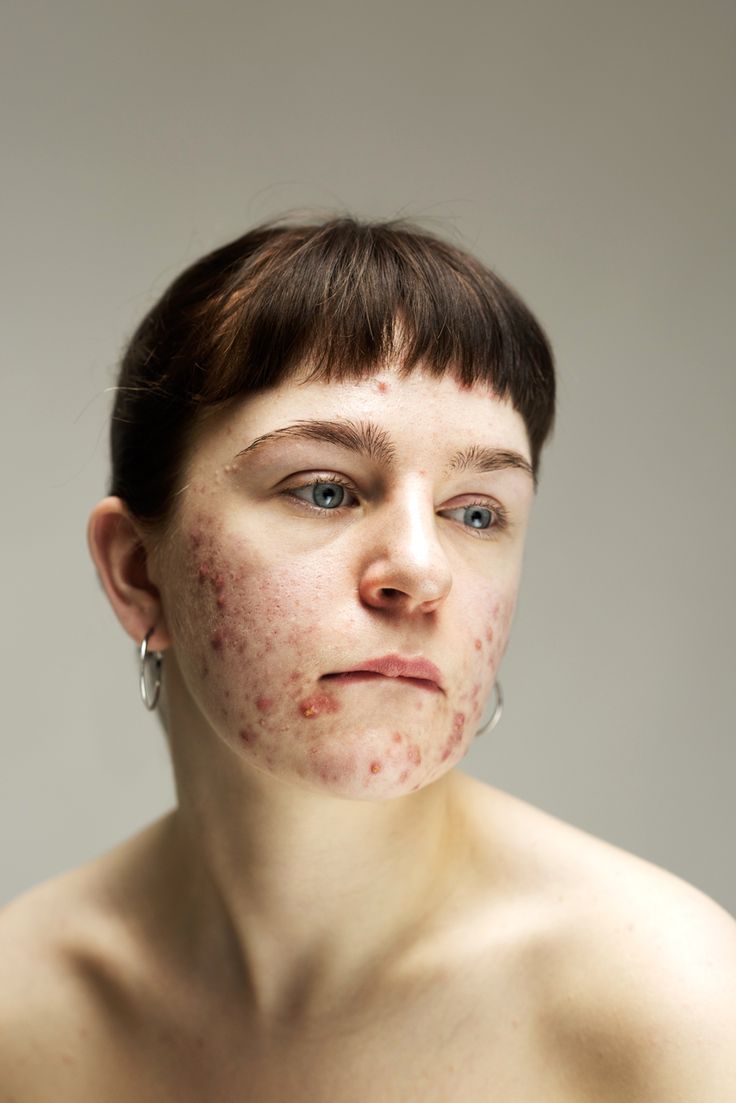 a woman with acne on her face