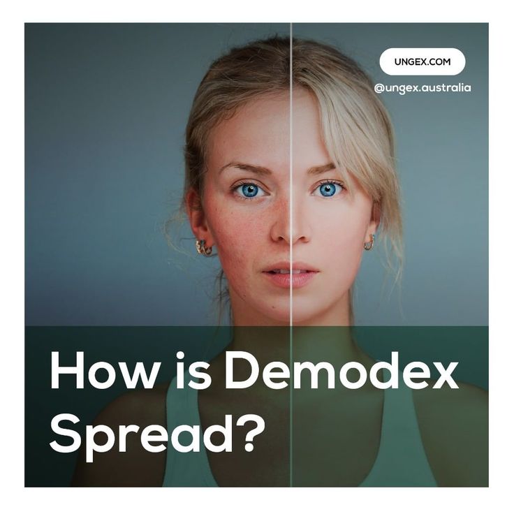 a woman's face is shown with the words how is demodex spread?