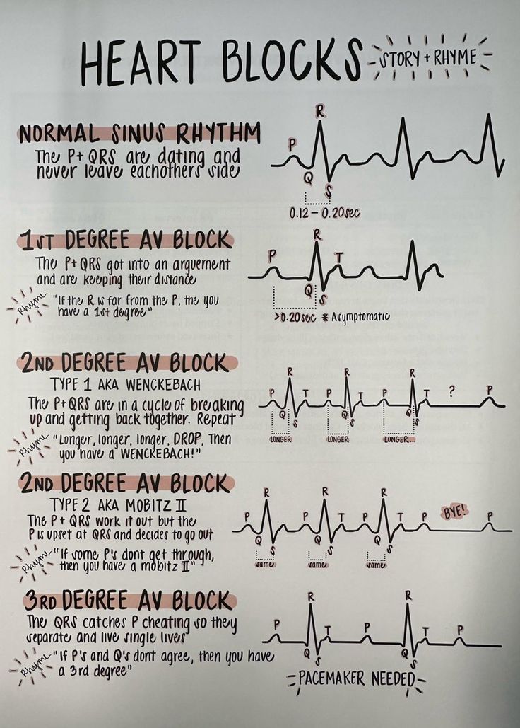 Cardiac Dysrhythmias Nursing, Cardiac Monitor Tech, Cardiology Medical Assistant, How To Read Ekg, Medical Student Notes Aesthetic, Med Surg Cardiac, Ekg Study Notes, Ekg Electrode Placement, Ekg Interpretation Made Easy Cheat Sheets