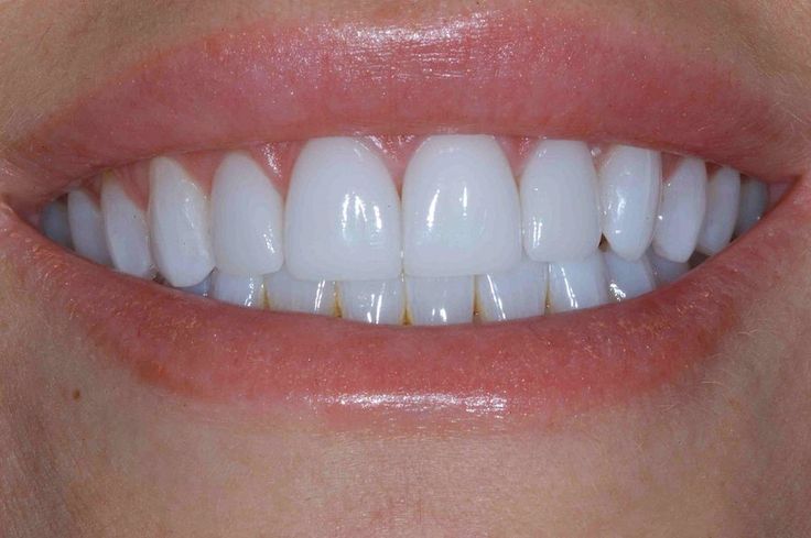 Natural Teeth Whitening Diy, Teeth Whiting At Home, Pretty Teeth, Veneers Teeth, Teeth Whitening Diy, Beautiful Teeth, Teeth Bleaching, Loose Tooth, Front Teeth