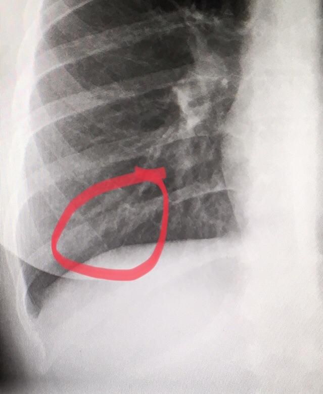 an x - ray shows a red circle in the chest