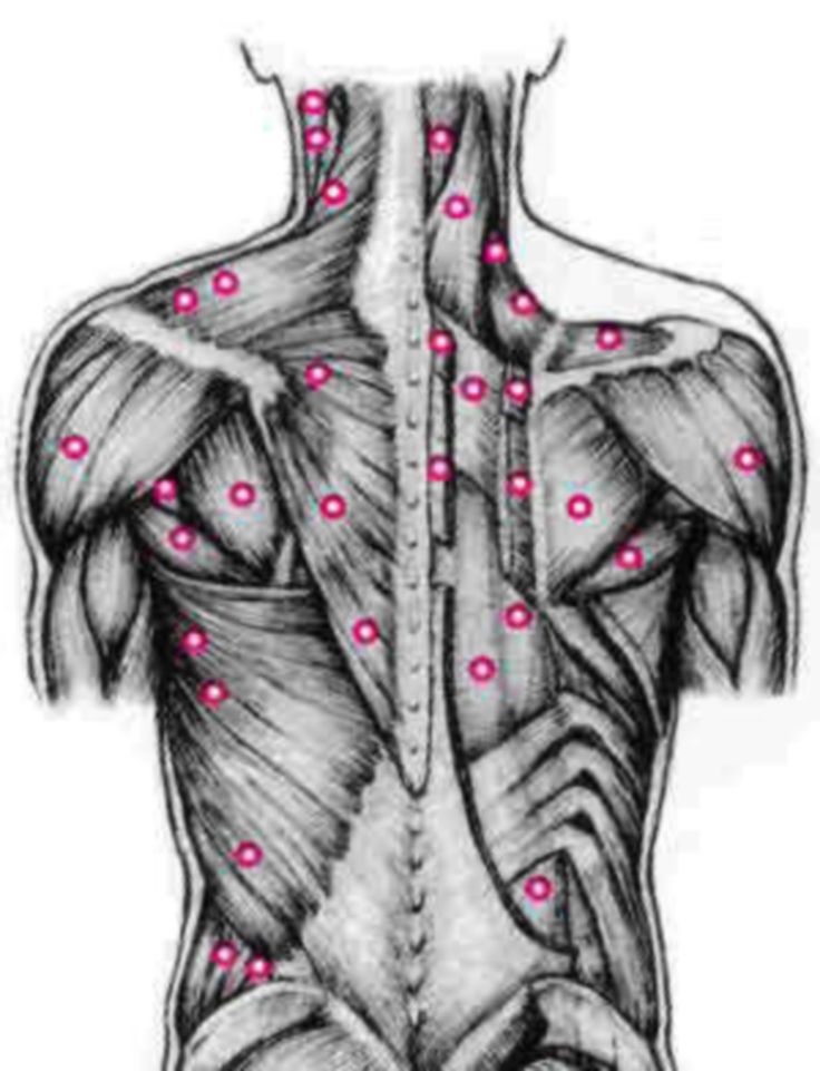 Trigger Point Therapy for Fibromyalgia and Knots Pinched Nerve Relief, Punkty Spustowe, Nerve Relief, Neuromuscular Therapy, Trigger Point Massage, Muscle Knots, Pinched Nerve, Trigger Point Therapy, Trigger Point