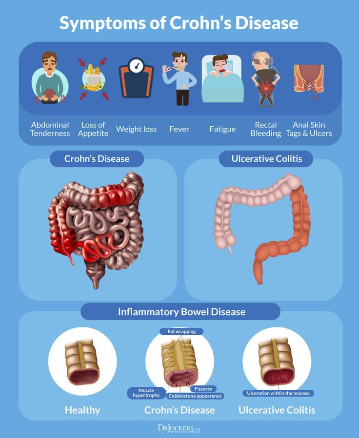 Natural Solutions to Crohn's Disease - DrJockers.com Chrones Disease, Crohns Symptoms, Crohns Diet, Chrons Disease, Irritable Bowel Disease, Muscle Hypertrophy, The Digestive System, Disease Symptoms, Decrease Inflammation