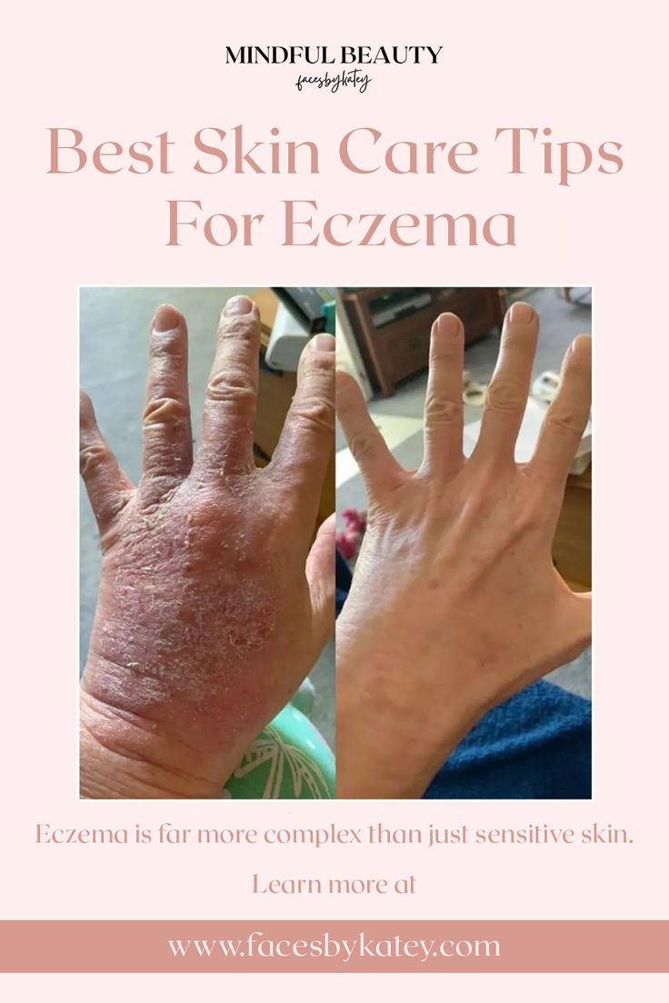 Learn what eczema and skin sensitivities are, and tips for how to care for eczema with skin care, common triggers, and more ways to support calm healthy skin. Treatments For Excema Natural Remedies, Excema Treatments Diy, Exema Treatments Natural, Severe Excema Remedies, Excema Remedies Diy, Common Triggers, Rash On Face, Dry Skin On Face, Dry Skin Patches