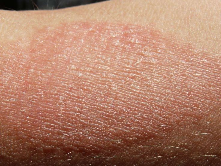 Many common issues can cause patches of dry skin, including cold weather, allergies, and certain medical conditions, including eczema and psoriasis. In this article, we look at symptoms, treatments, and pictures of dry skin patches. Dry Skin Pictures, Dry Patches On Skin, Skin Allergy Pictures, Skin Rashes Pictures Types Of, Dry Spots On Face, Dry Skin Patches On Face, Dry Patches On Face, Skin Conditions Pictures, Skin Rashes Pictures