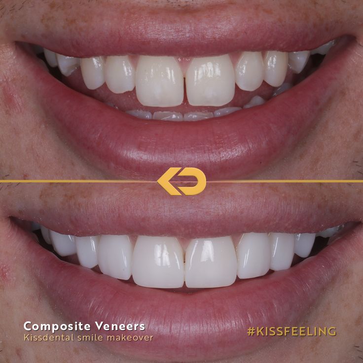 Dental Composite Veneer, Composite Bonding Before And After, Composite Veneers Before And After, Veneers Before And After, Composite Bonding Teeth, Teeth Composite, Teeth Makeover, Dental Cover, Composite Bonding