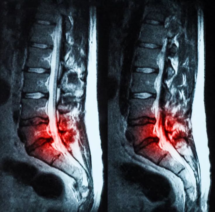 Symptoms of Severe Spinal Stenosis of L4-L5 | Premia Spine Spinal Nerves Anatomy, Stenosis Of The Spine, Spinal Degeneration, Nerve Anatomy, Sciatic Nerve Pain Relief, Sciatica Symptoms, Spine Pain, Nerve Health, Spinal Surgery